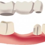 Dental Bridges