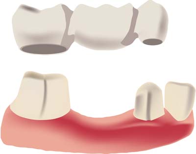 Dental Bridges