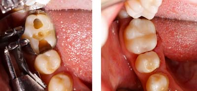 Tooth Colored Dental Fillings