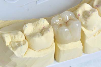 Dental Crowns