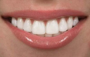 Dental Veneers