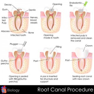 Root Canal Therapy