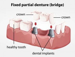 Bridge Implant