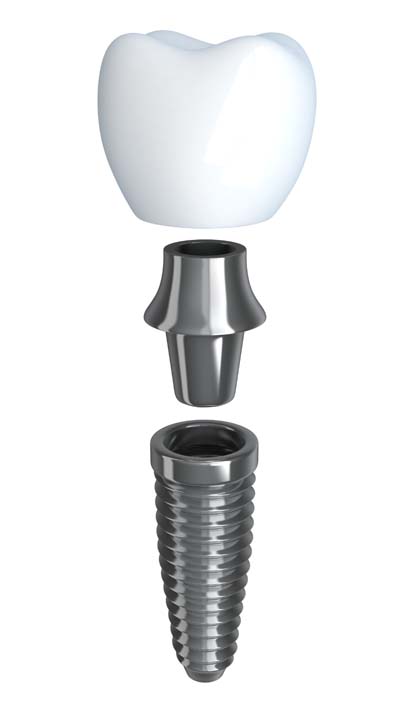 Tooth implant 