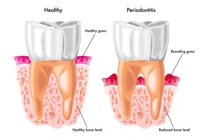 Periodontal Disease, Periodontal Therapy