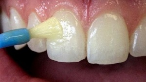 Varnish Fluoride Treatment