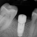 implant website