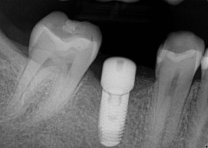 implant website