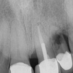 14Sept16ENDOSimmons resorption01 website
