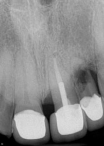 14Sept16ENDOSimmons resorption01 website