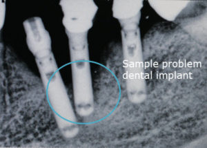Mexico Dentist Sample Problem Dental Implant