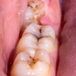 depositphotos 473944922 stock photo caries mouth chewing teeth installation website
