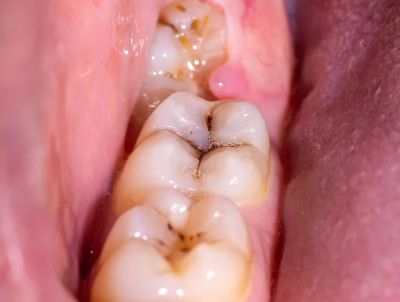 depositphotos 473944922 stock photo caries mouth chewing teeth installation website